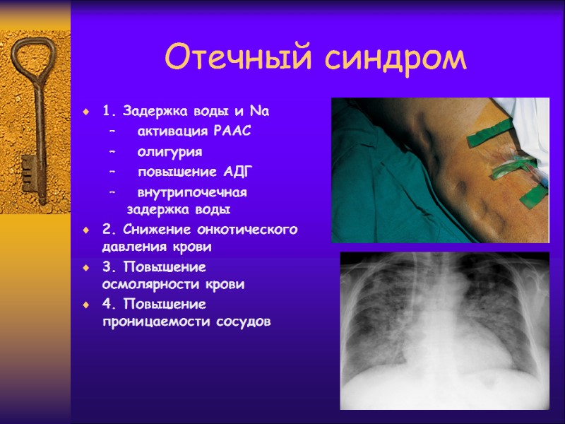 Отечный синдром 1. Задержка воды и Na  активация РААС  олигурия  повышение
